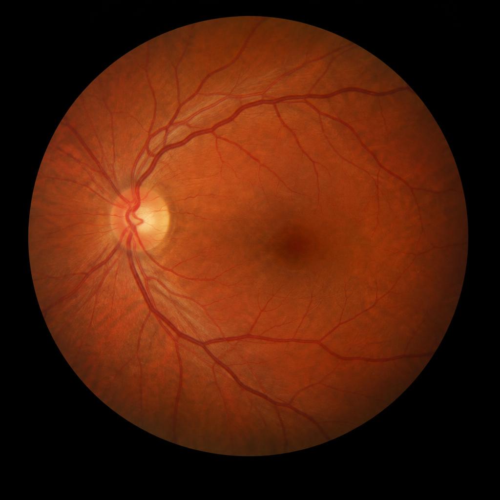 Retinal fundus photograph of the back of the eye